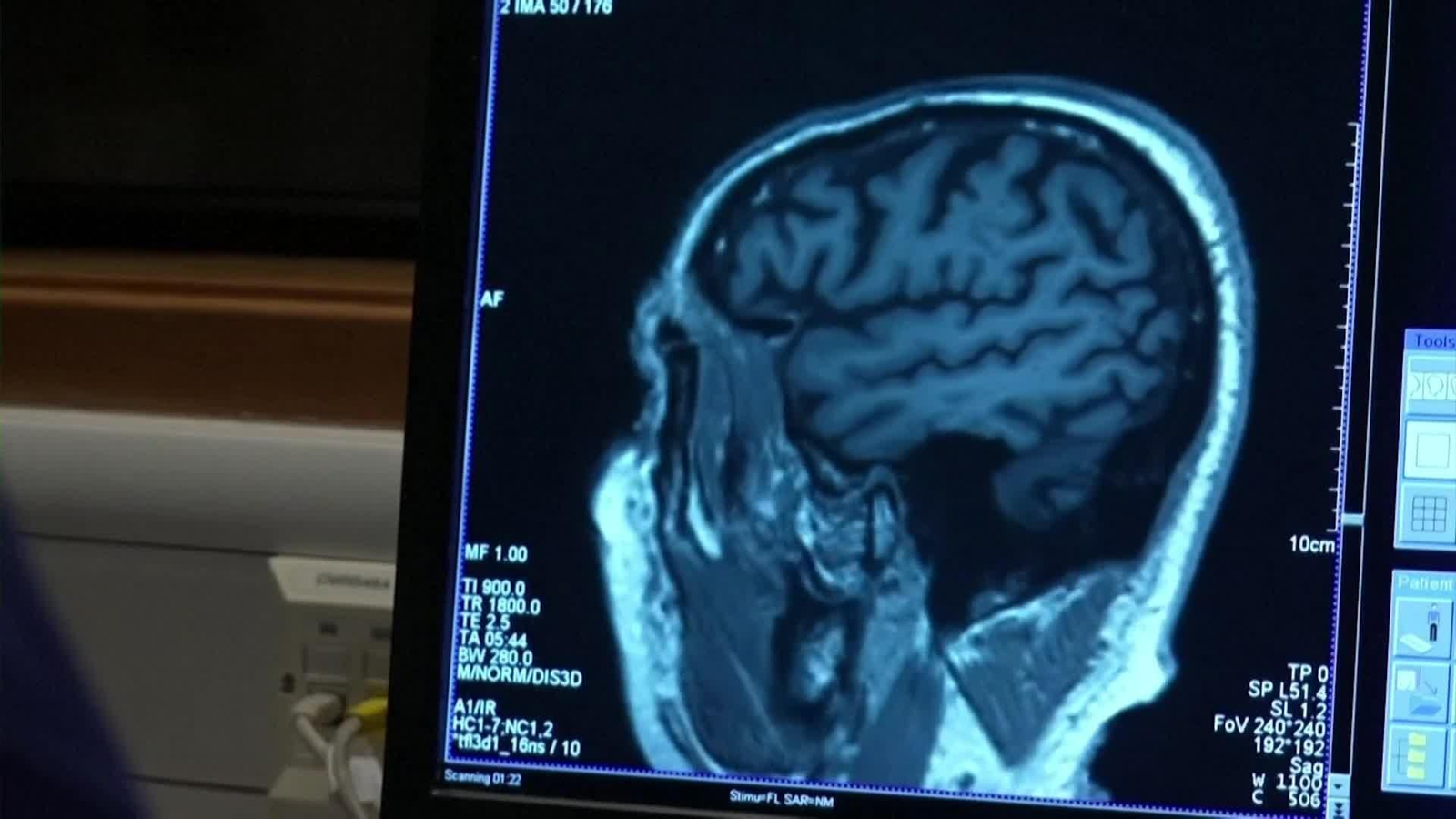 web litio y alzheimer