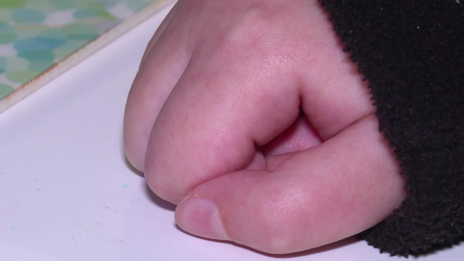 La vida de León con medio cerebro