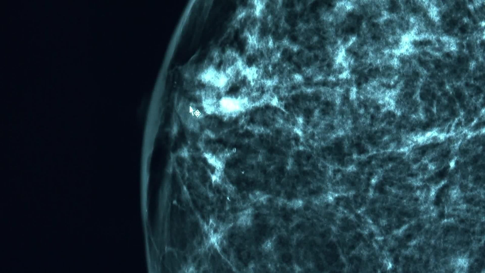 web ia y cancer