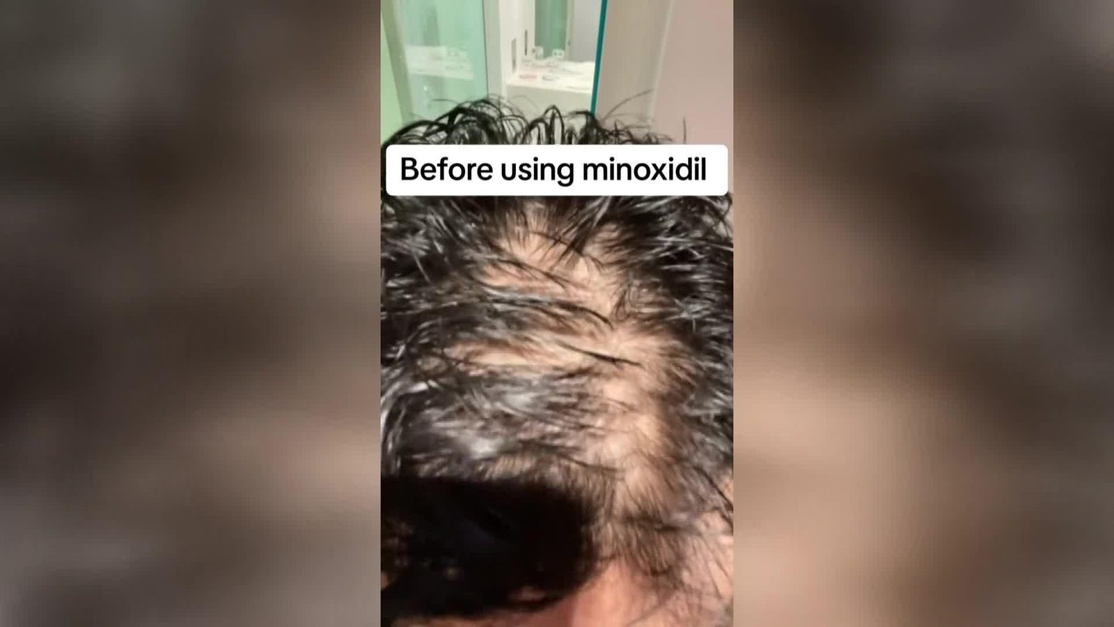M064-EDI VARIOS DESABASTECIMIENTO MINOXIDIL