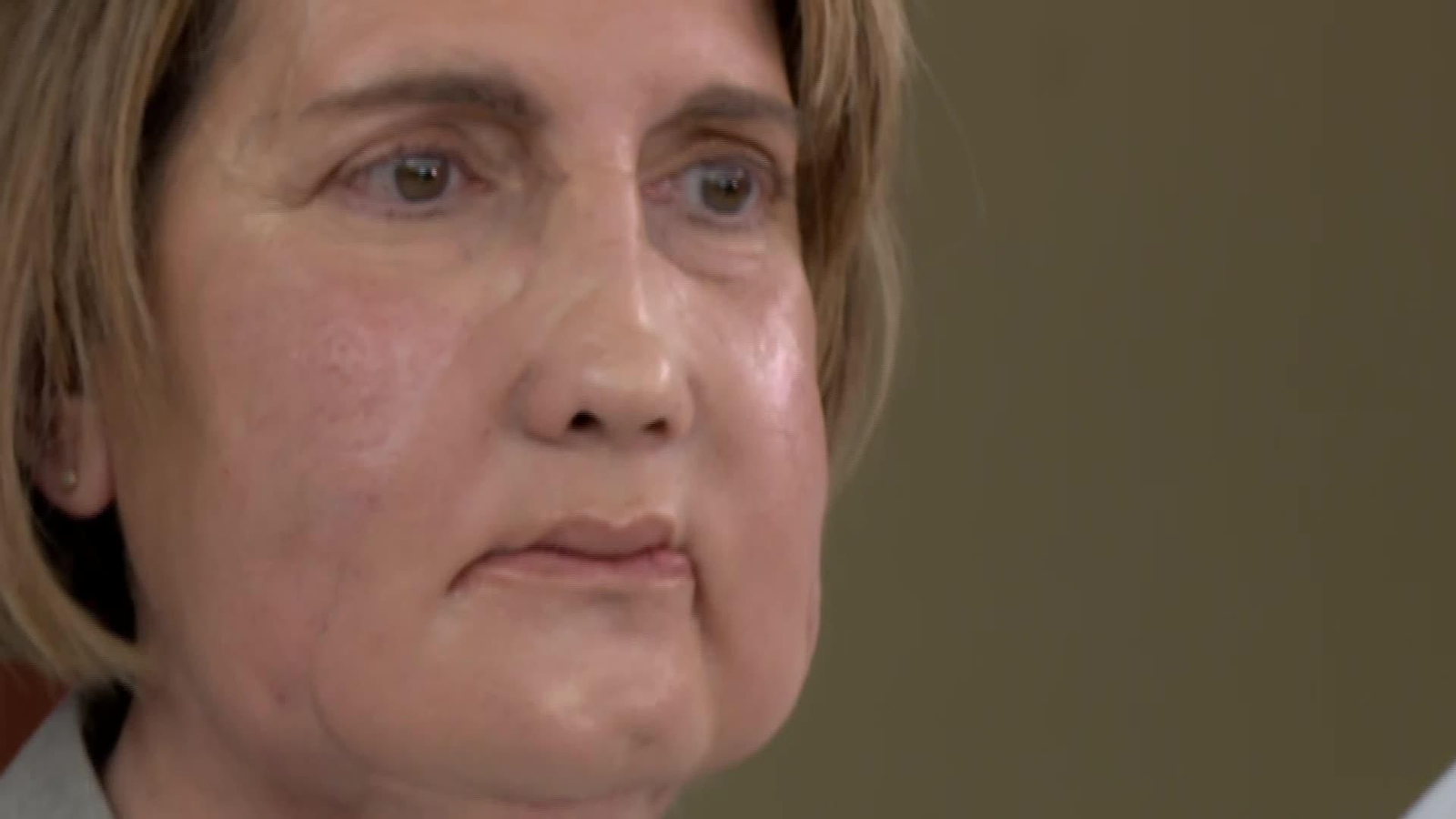 L067-EDI BARCELONA TRASPLANTE DE CARA