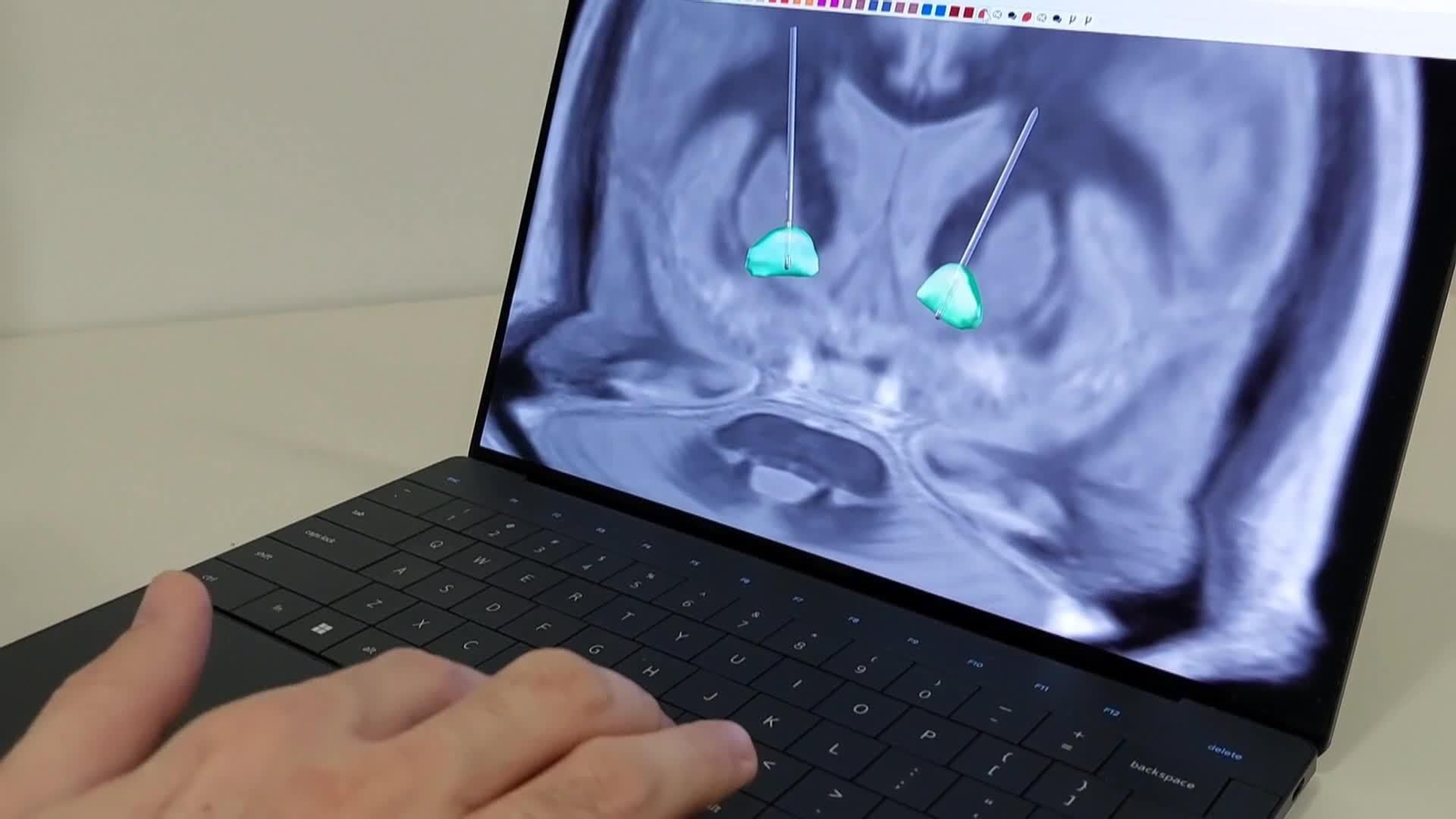 web exito sindrome tourette