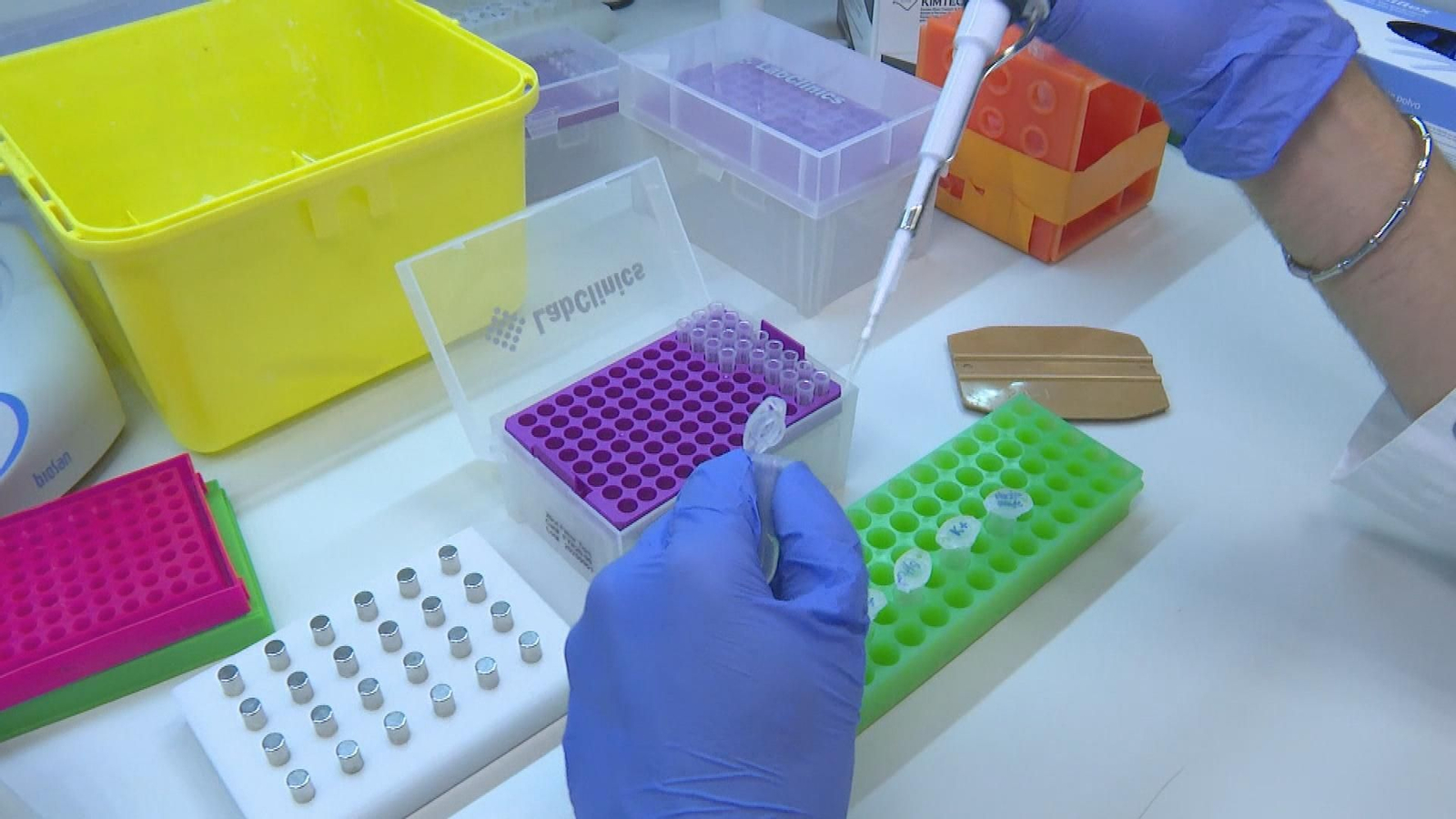 Biopsia líquida cáncer de mama