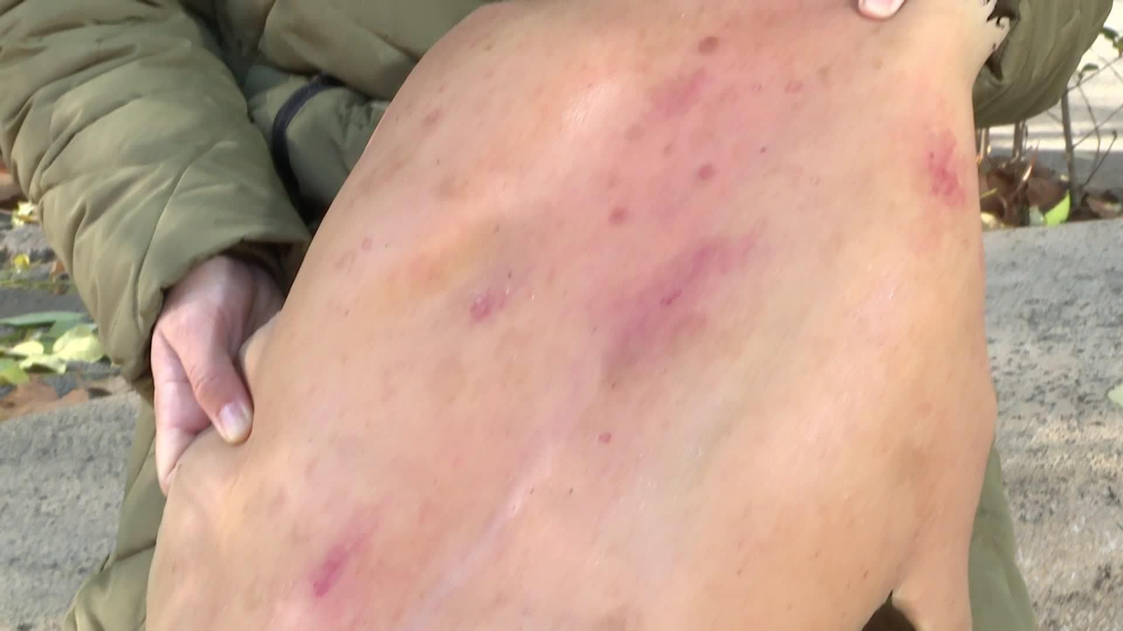 web vivir con dermatitis