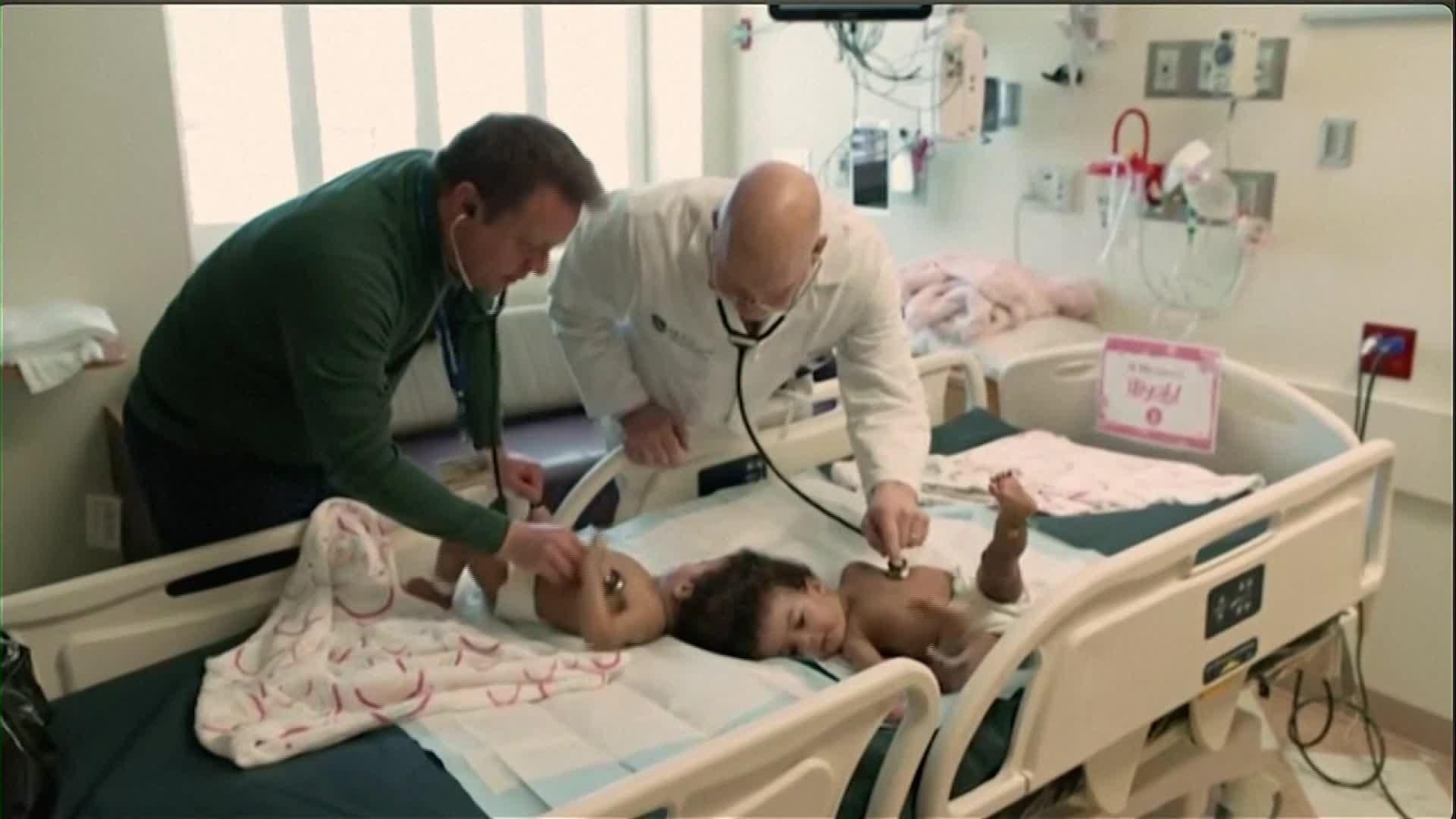 J022-EEUU SEPARACION SIAMESAS