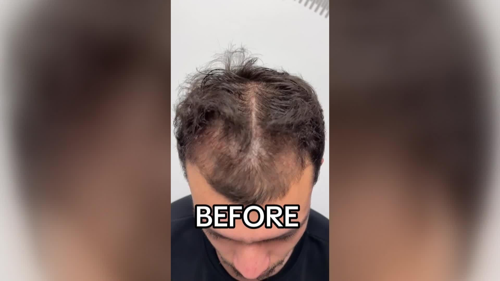 web minoxidil
