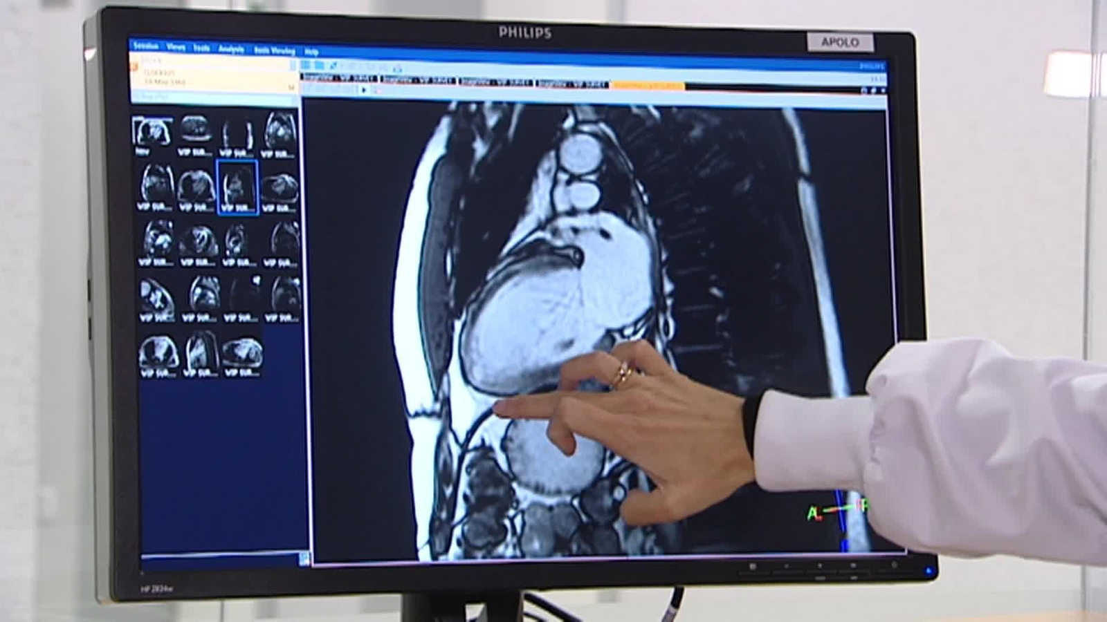 web betabloqueantes infartos