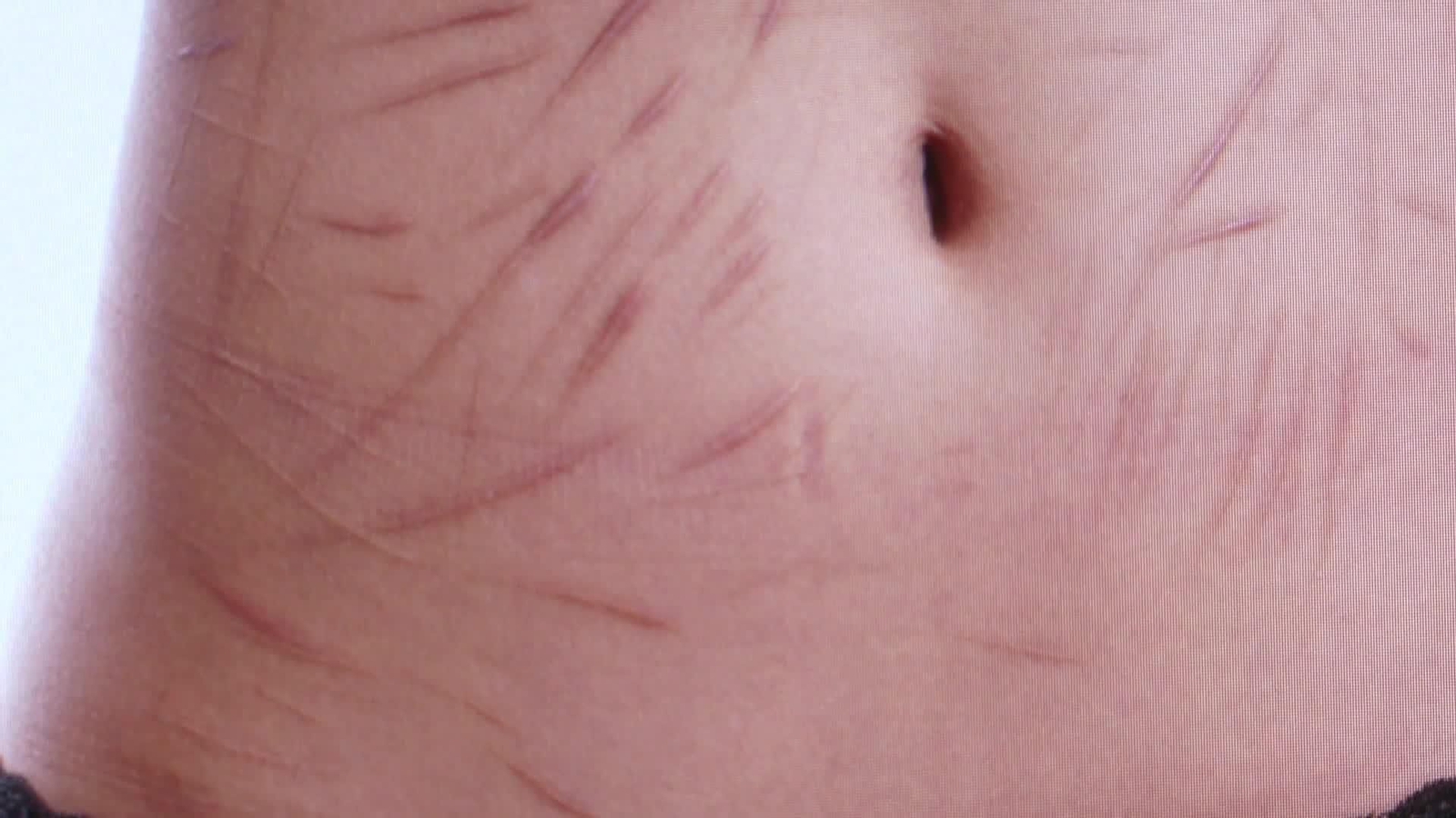 Un tercio de los jóvenes reconoce haberse autolesionado alguna vez